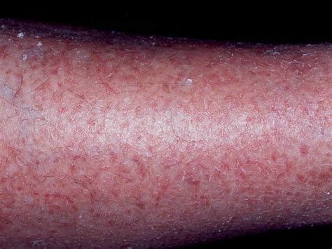 eczema craquele pictures.